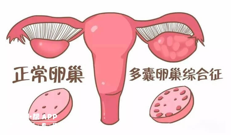 多囊卵巢患者可选择做试管婴儿