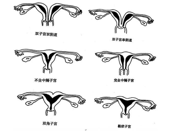 子宫畸形是环境因素还是染色体异常造成的呢？