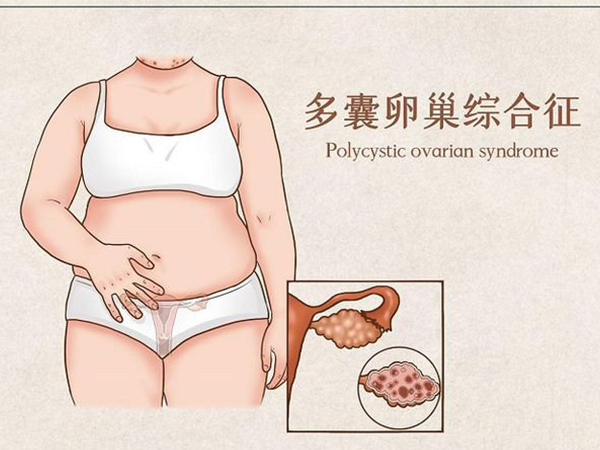 多囊治疗后月经周期规律能快速自然受孕？
