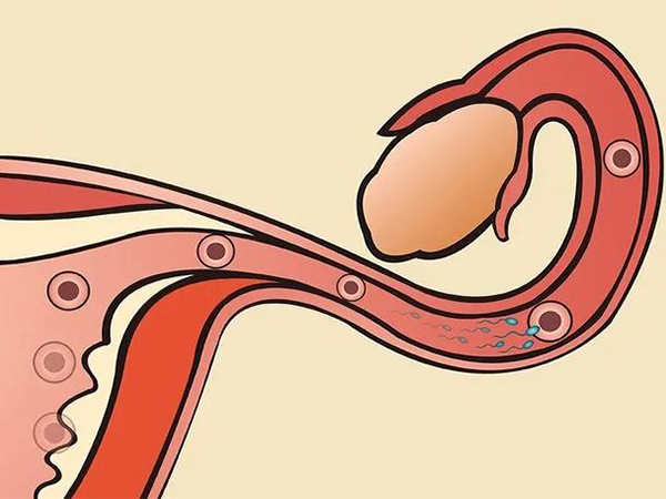 输卵管两侧都堵塞发生宫外孕的几率大吗?