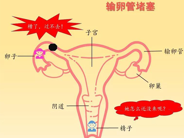 输卵管单侧堵塞试管移植后会造成宫外孕吗？