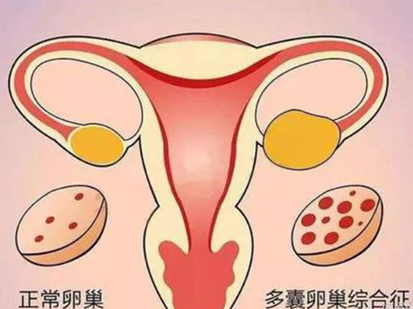 多囊卵巢积极治疗后会怀上孩子吗？