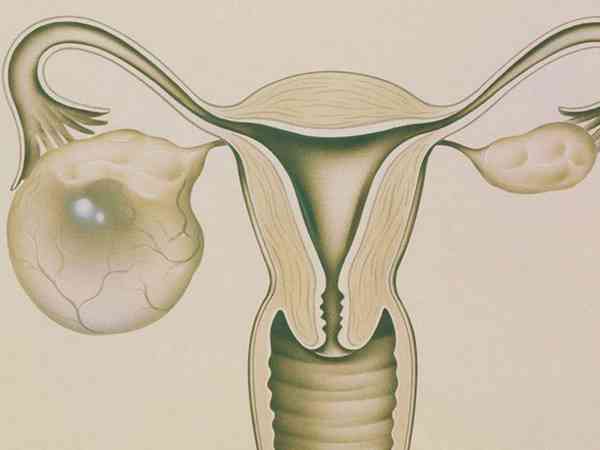 喝豆浆会加快5cm的病理性卵巢囊肿生长吗？