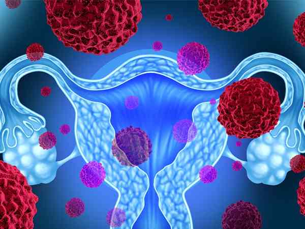 糖类抗原72—4是卵巢肿瘤的指标吗？