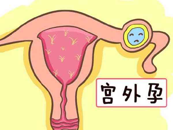 单角子宫做试管容易宫外孕吗？