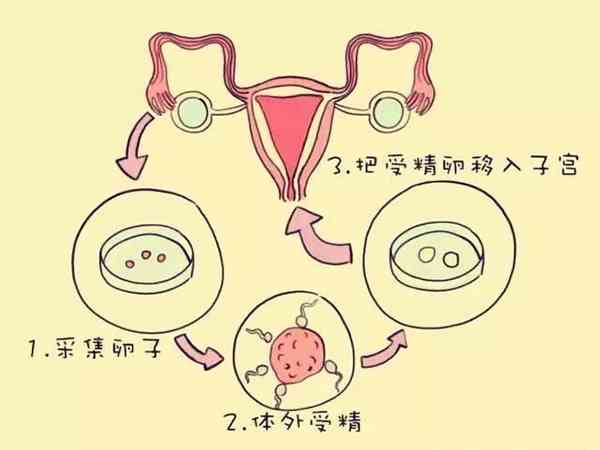 鹿泉做试管婴儿的全部过程分为哪几个步骤？