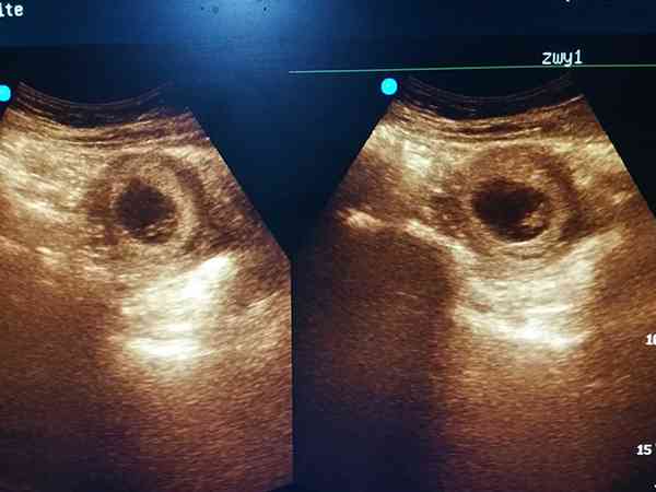 40天的男孩孕囊图片图片