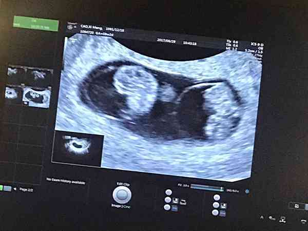 怀双胞胎孕早期孕酮一般多高才正常？