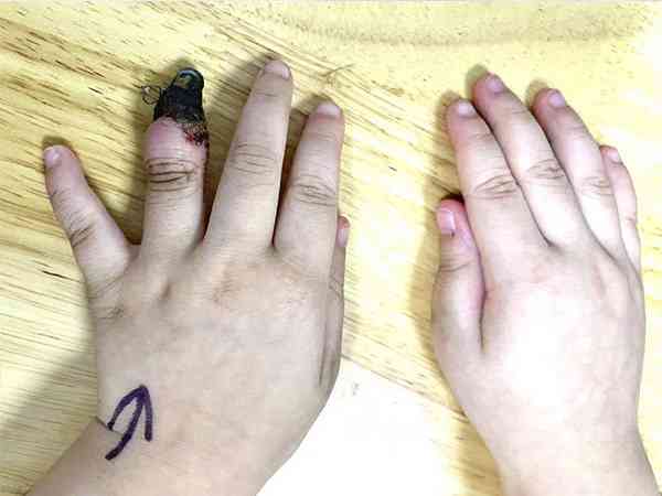 家人错误包扎怎么会导致3岁女童手指坏死截指？