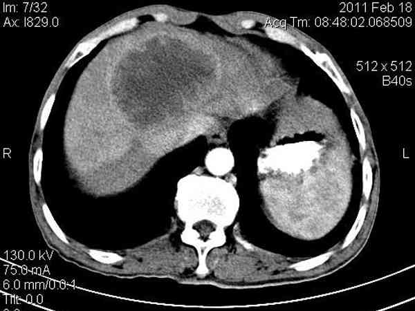 孕妇做肺部64排CT平扫会造成孩子畸形吗？