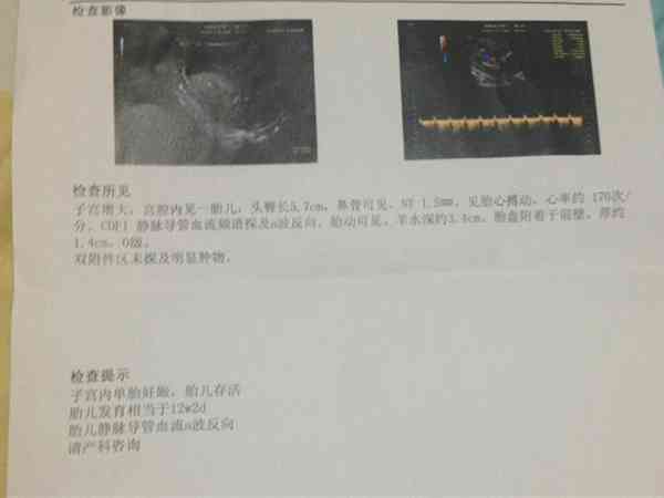 孕12周b超提示静脉导管A波反向表示什么问题?