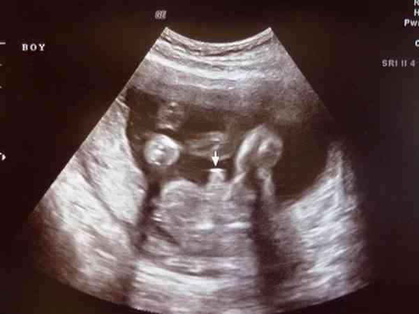 孕囊大、胎芽小、胎心弱、hcg下降，是胚胎发育迟缓吗？
