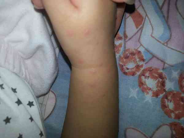 一岁宝宝发低烧后双手臂起大片疹子是幼儿急疹吗？