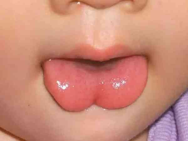 宝宝舌苔突然破了是生病引起的吗？
