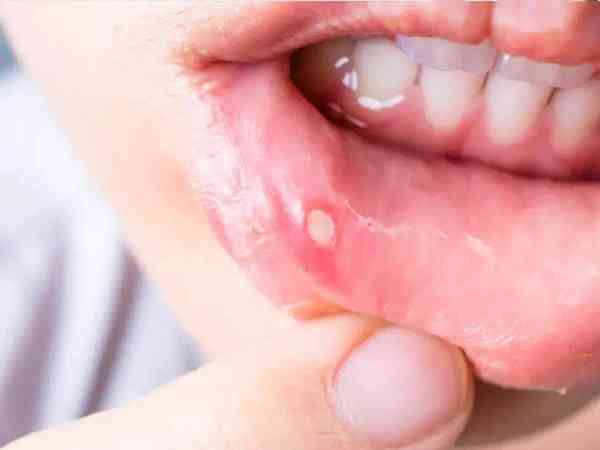宝宝发烧完嘴里起疱疹吃什么食物比较好？