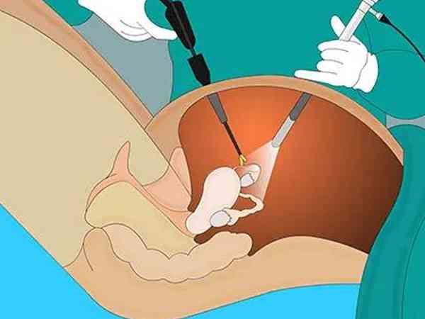 孕妇做卵巢囊肿手术最佳时间是怀孕第几周？