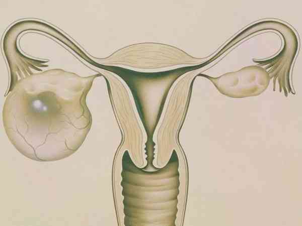 妊娠合并卵巢交界性肿瘤必须要剖宫产吗？