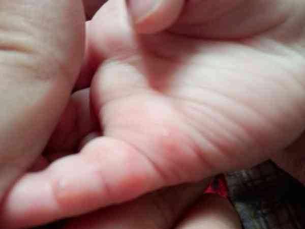 宝宝手掌有透明水泡是手足口病还是疱疹？