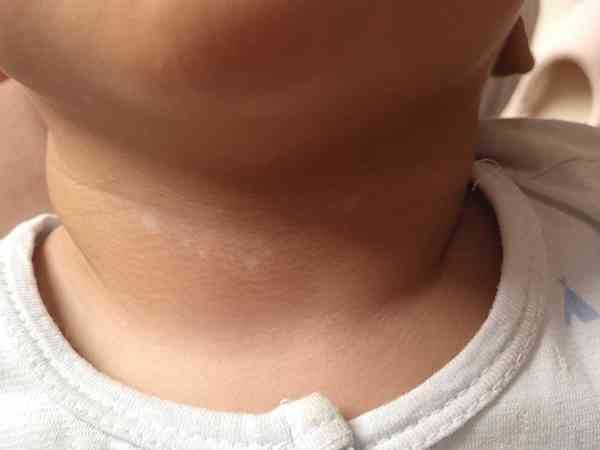 宝宝脖子褶皱处有无色素痣，不痛不痒问题大吗？