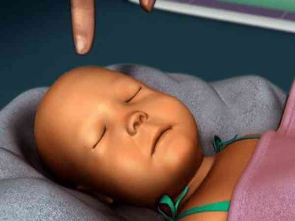 满月宝宝黄疸7点几，脸微黄能接种疫苗吗？