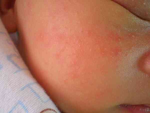 宝宝眼下湿疹一直反复不好是过敏体质吗？