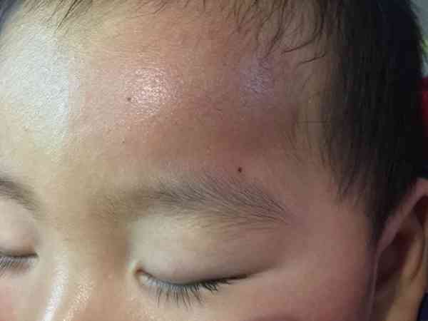 两岁宝宝额头摔红肿了应该怎么消肿止痛？