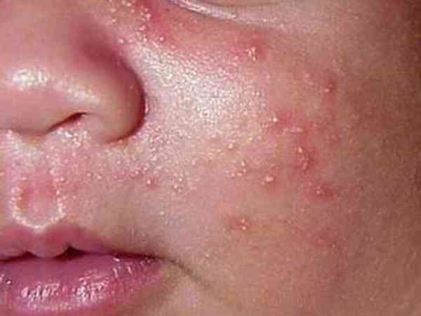 新生儿脸上出皮疹是食物过敏引起的吗