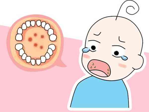 九岁宝宝喉咙吞咽疼痛有白色泡是疱疹性咽峡炎吗？