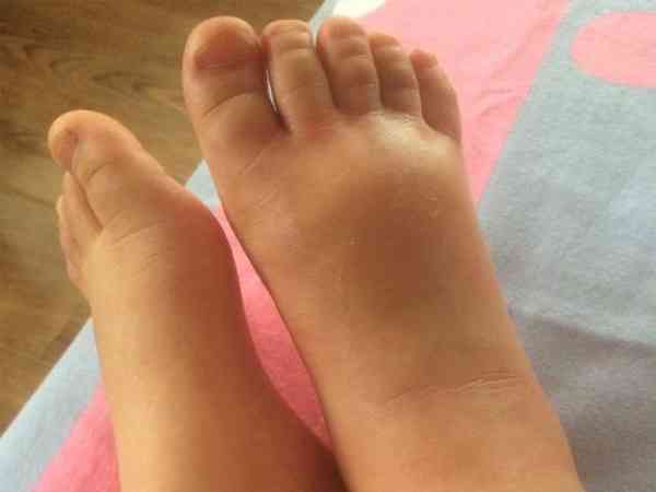 孩子脚背磕伤红肿面积大，48小时内能冰袋冷敷消肿吗？