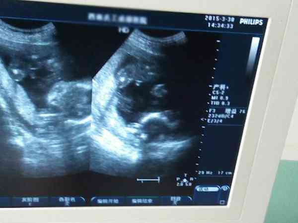 孕19周B超检查报告提示胎盘有点低置问题大吗？