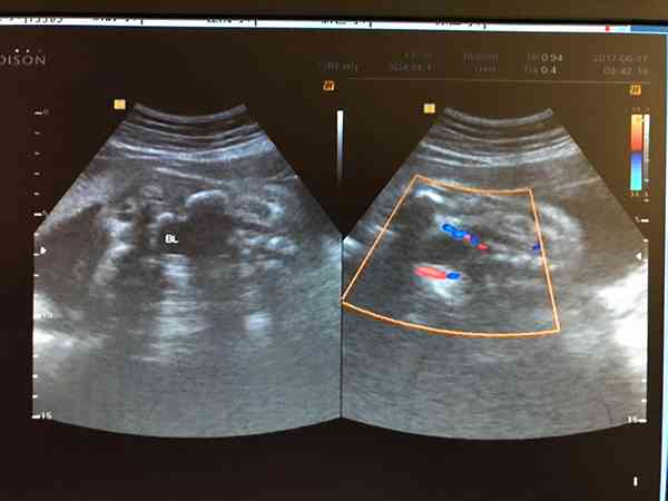 预产期前两天b超显示胎儿膀胱上方有囊肿要怎么处理？