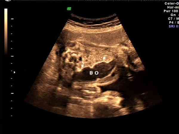 孕25周胎儿下腹部肠管较宽，会是胎粪性肠梗阻吗？