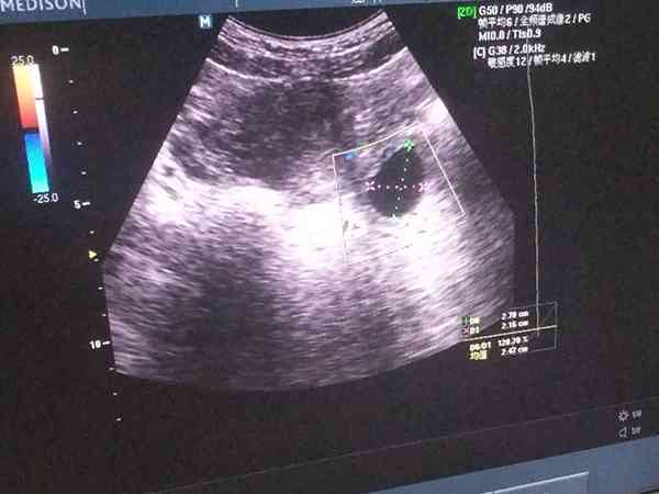 孕8周孕囊直径28mm没胎心胎芽最多还可以等多久？