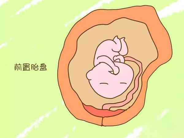 高龄孕妇孕晚期部分性胎盘前置晚上睡觉怎么躺好？