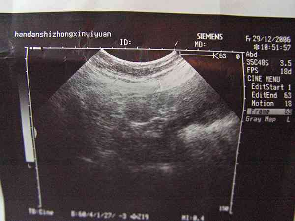 孕24周大排畸胎儿腹围172mm在正常范围内吗？