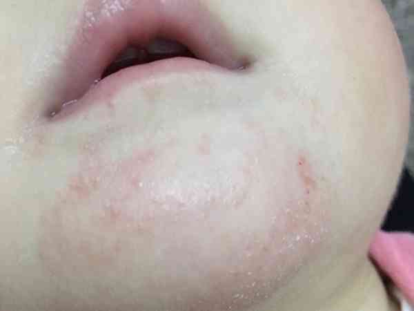 宝宝喝奶粉过敏除了脸上起湿疹还会有哪些明显症状？