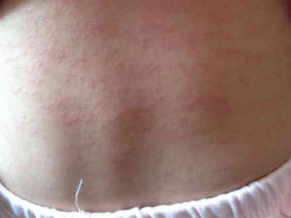 宝宝发烧一周后屁屁起小疹子蔓延到背部是幼儿急疹吗？