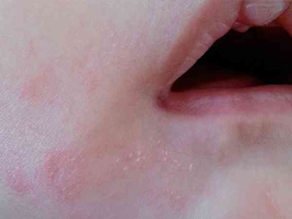 四个月宝宝嘴边皮肤粗糙泛红是经常流口水导致的吗？
