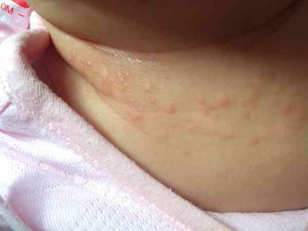 宝宝脖子上有颗粒状湿疹且干燥脱皮怎么处理能去除？