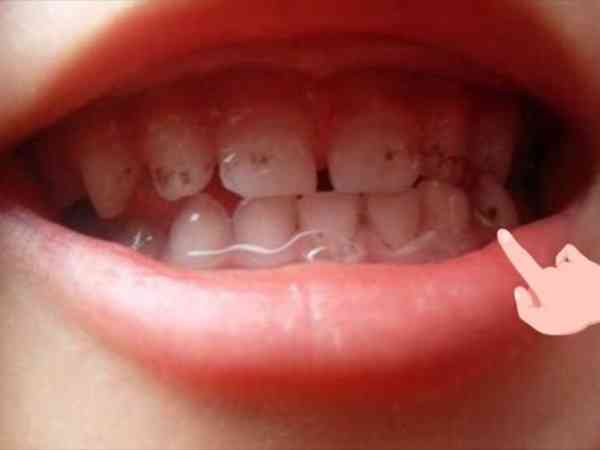 宝宝门牙表面有黑点刷不掉是牙菌斑还是龋齿？