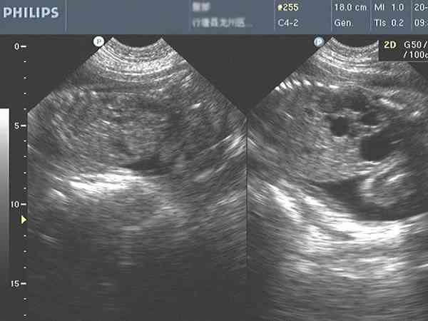 孕24周左侧多囊性肾发育不良的胎儿生下来有哪些风险？