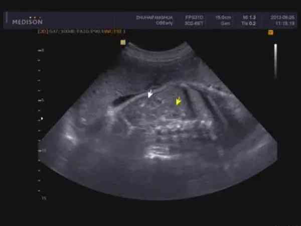 胎儿右侧重复肾出生后再治疗，孕期要注意什么？