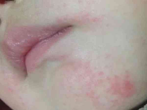 宝宝下巴和鼻子周边泛红起一粒一粒的小疹子是口水疹吗？