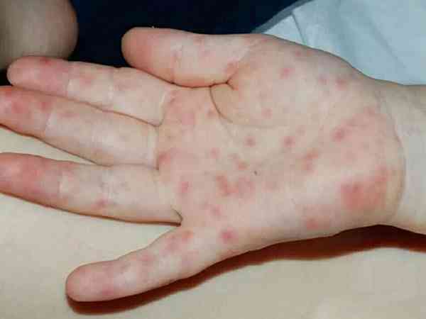 德尔塔病毒的皮疹图片图片
