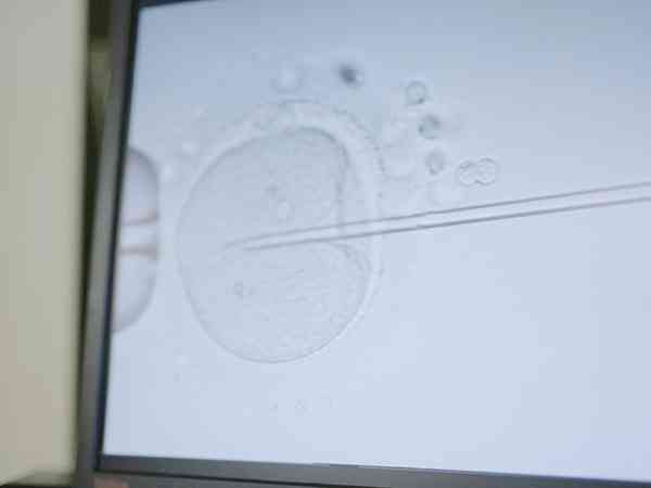 青海红十字医院二代试管婴儿单个精子注射要多少钱？