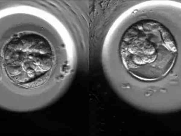 山东私立生殖医院冻囊胚一般是移植几个？1个还是2个？