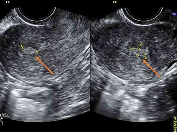 移植囊胚前一共要查几次内膜才能找到移植窗口期？