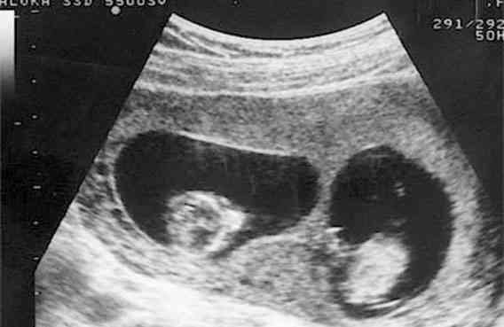 两步移植法移植两个胚胎成双胞胎的多吗？