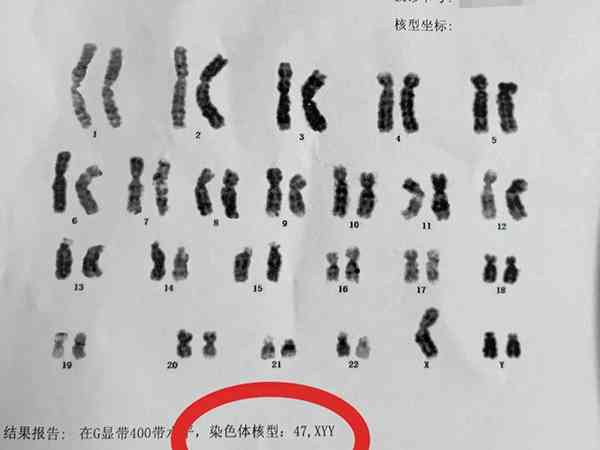 染色体47xxx可以做三代试管生孩子吗？