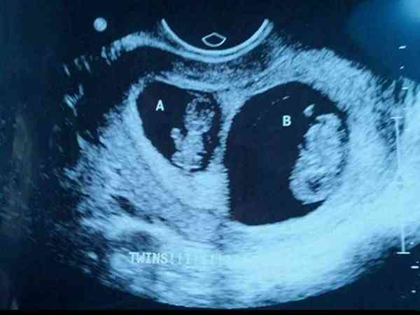 为什么有的人12周产检变双胎？